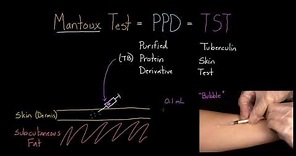 Mantoux Test (aka. PPD or TST)