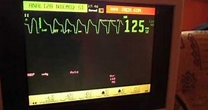 EKG Monitor