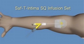 How to Insert Saf-T-Intima™ SQ Infusion Set