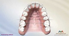 Orthodontic Space Management - TPA Appliance