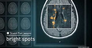 Multiple Sclerosis: Understanding Your MRI