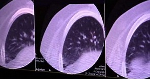 5mm Left Lobe lung Nodule Skinny Core Co-axial Biopsy