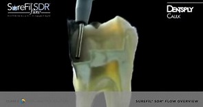 Watch the Revolutionary SureFil® SDR® flow Flowable Composite in Action | Dentsply Sirona