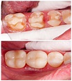 Dental Inlays and Onlays - Siam Station Dental Clinic