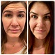 BOTOX 101: Everything You Need to Know + Before & After Photos ...