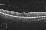 Evolution of VMT - OCT 3 at 8 months - Retina Image Bank