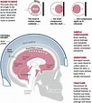 Concussion Physics - Health Special: Kids and Concussions - TIME