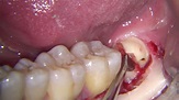 Fast lower wisdom tooth surgical extraction - YouTube