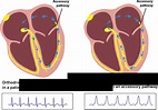 File:OCT ACT.svg - Textbook of Cardiology