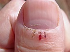 All about Hangnail; Causes, Symptoms and Treatment
