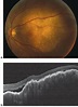 Optical coherence tomography (OCT) - American Academy of Ophthalmology