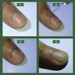 Hangnail: A simple solution to a common problem - Journal of the ...