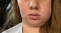 Swollen face after wisdom tooth removal | BabyCenter