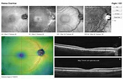Index of /oct-retina/plaquenil/files