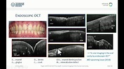 Julia Walther: Optical coherence tomography in the oral cavity - YouTube