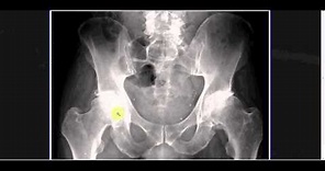Interpreting X-Rays of the Pelvis, Hip Joint and Femur