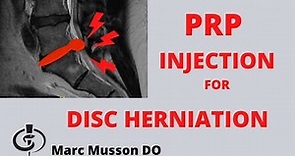 PRP Injection For Disc Herniation | Platelet Rich Plasma Epidural Injection